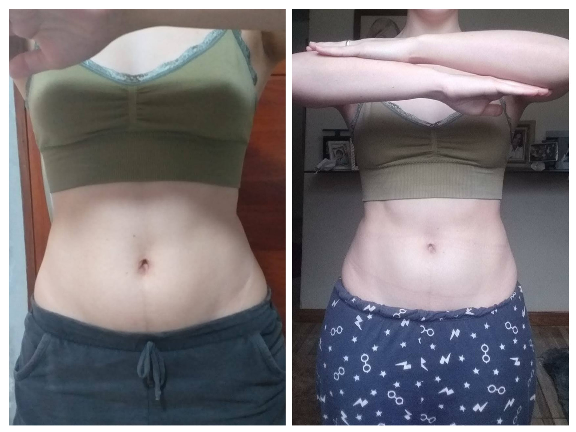 Antes e depois de aluna — vista frontal do abdômen